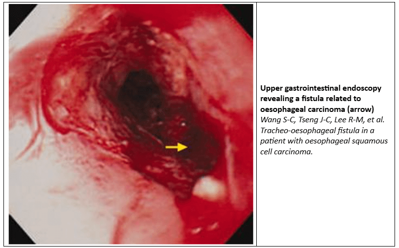 reflux & vomiting
